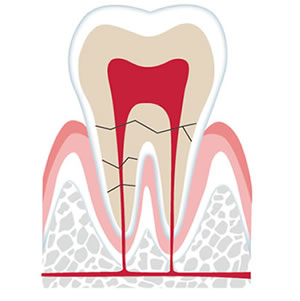 レーザー保存治療(歯根破折の治療)
