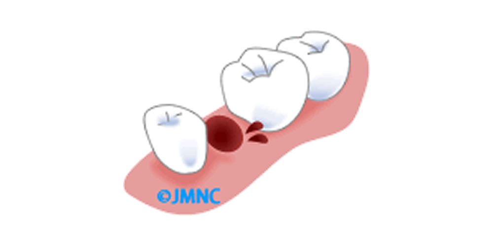 親知らず 抜歯 血 が 止まら ない