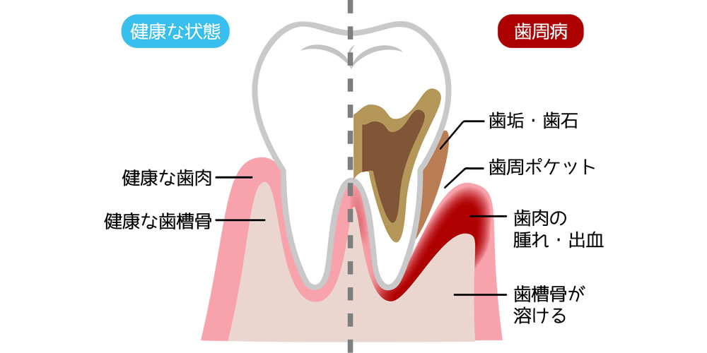 歯周病が進行した場合に現れる症状