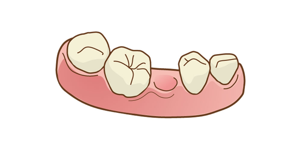 歯を失ったまま放置することで起こるリスク