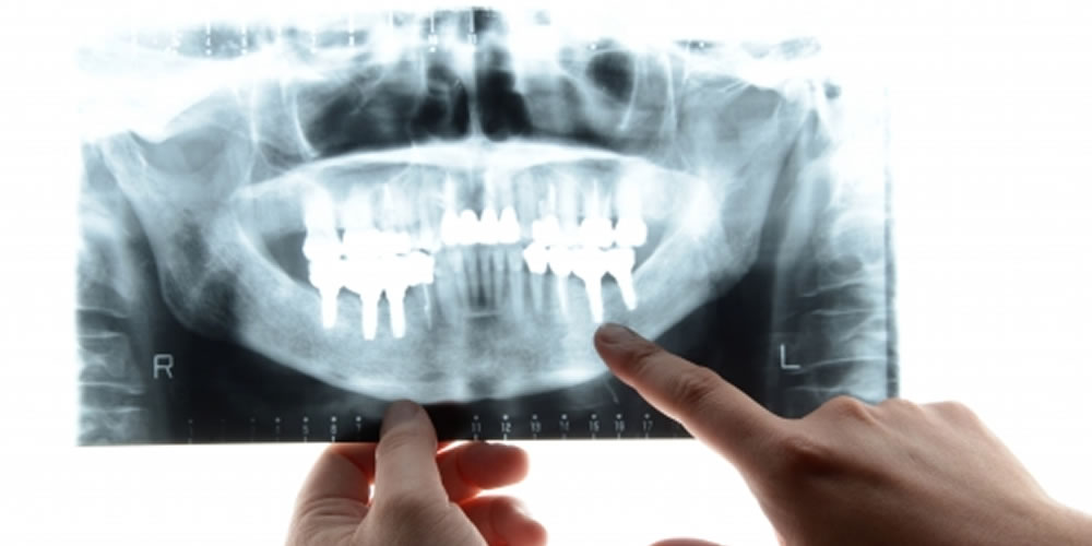 インプラント治療に伴うリスク・注意点