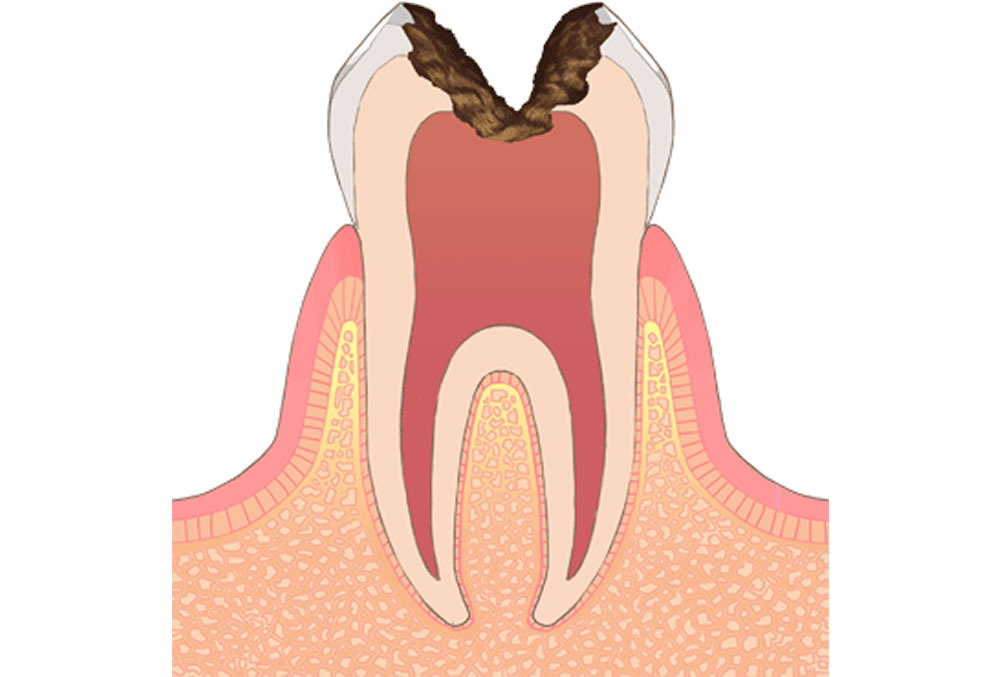 神経にまで進行した虫歯
