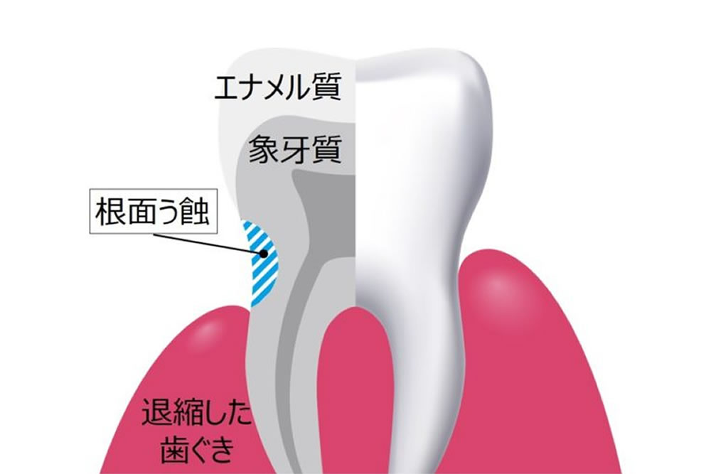 根面う蝕