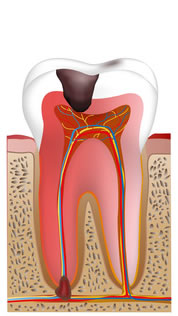 神経に達した虫歯