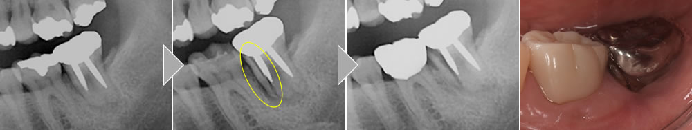 歯根破折の治療症例