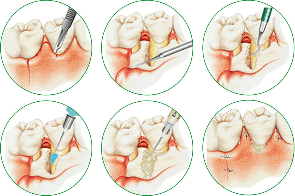 歯周組織再生療法