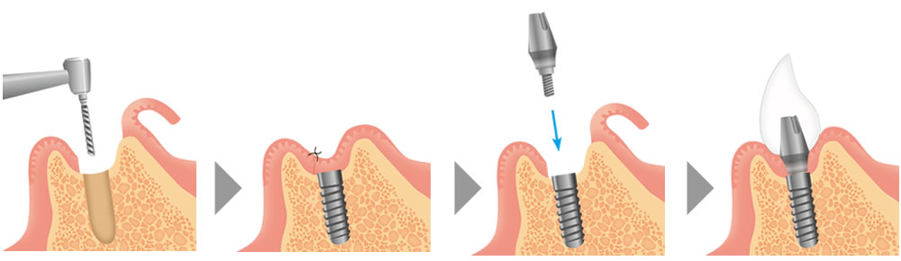 インプラント治療の手順