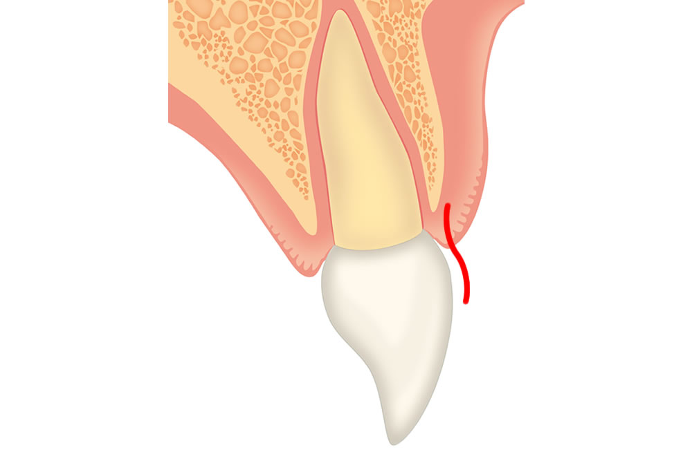 S shape profile