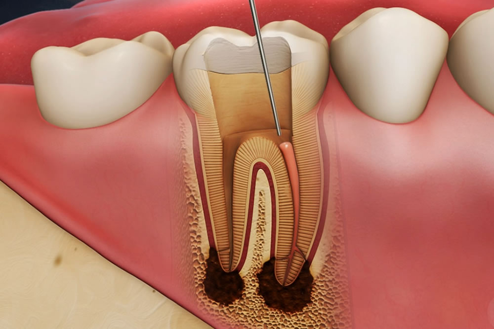 根管治療