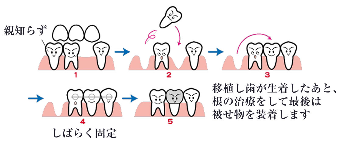 親知らずの抜歯・保存