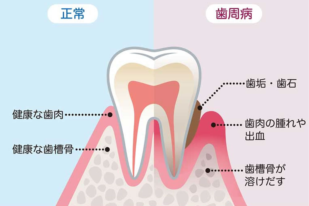 歯周病の症状