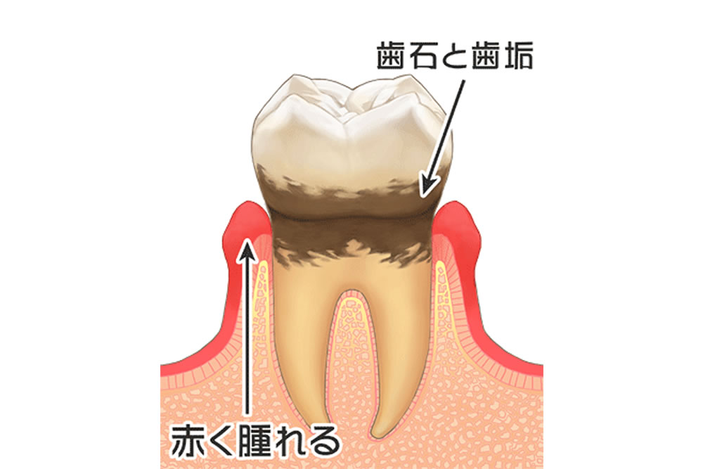 歯肉炎