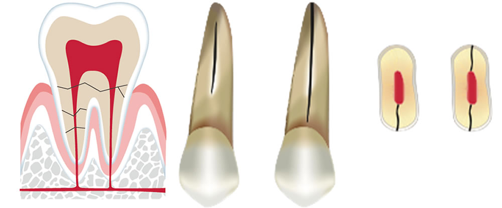 歯根破折