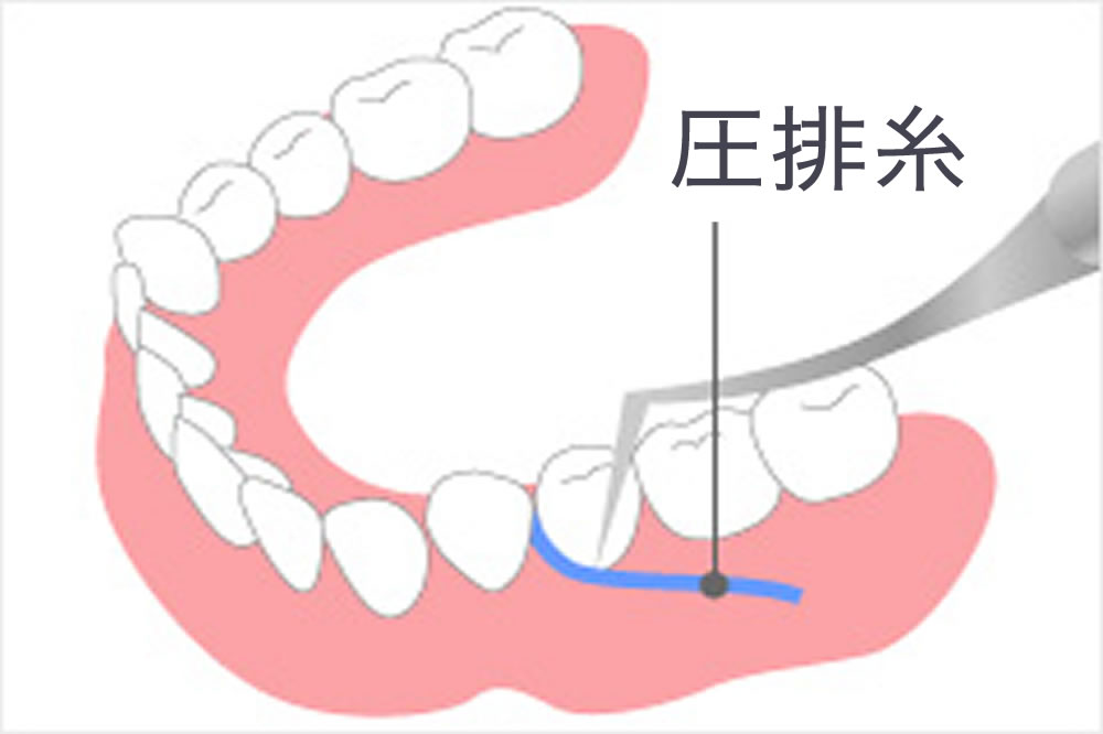 S shape profile